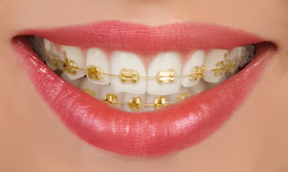 Ceramic Braces  Grant Orthodontics