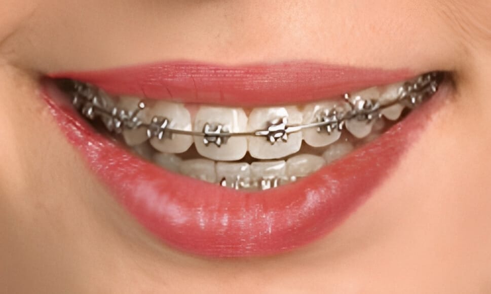 Close-up of smiling mouth displaying metal braces on upper teeth with pink lips.