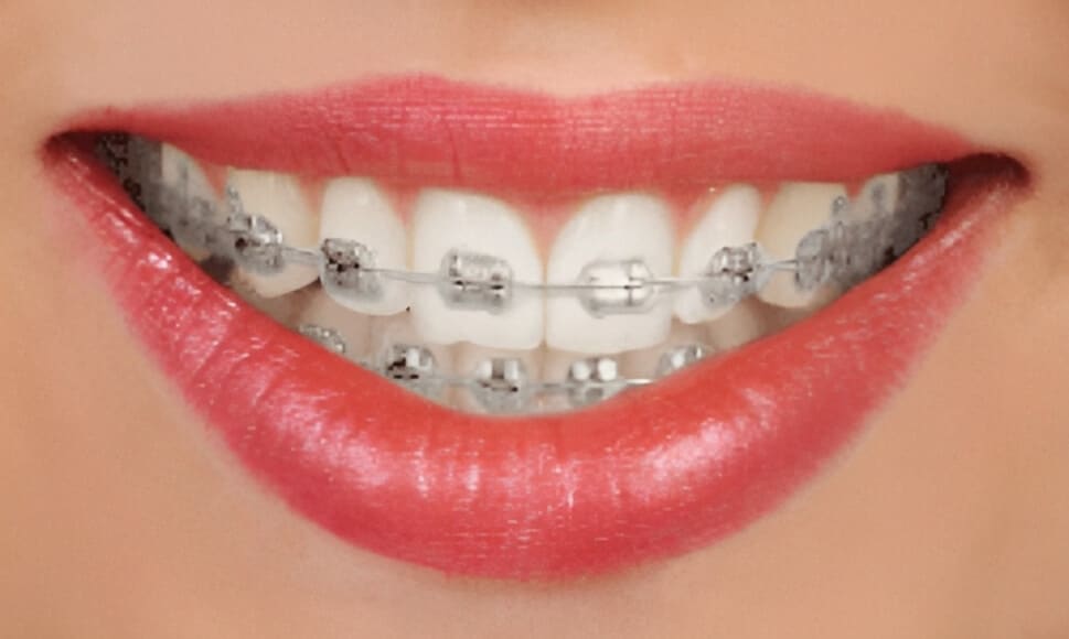 Close-up of smile showing metal braces on upper teeth with pink lipstick applied.