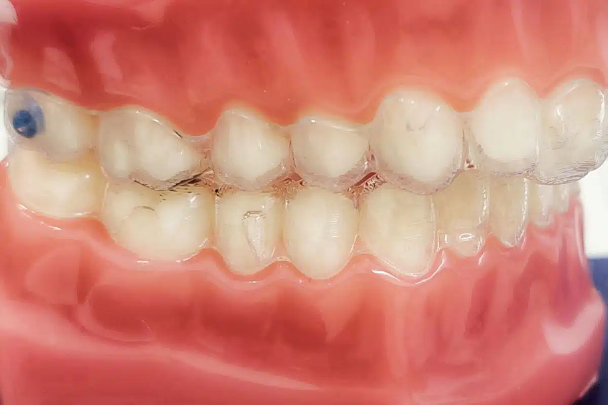 How Long Does It Take to Fix an Overbite with Invisalign